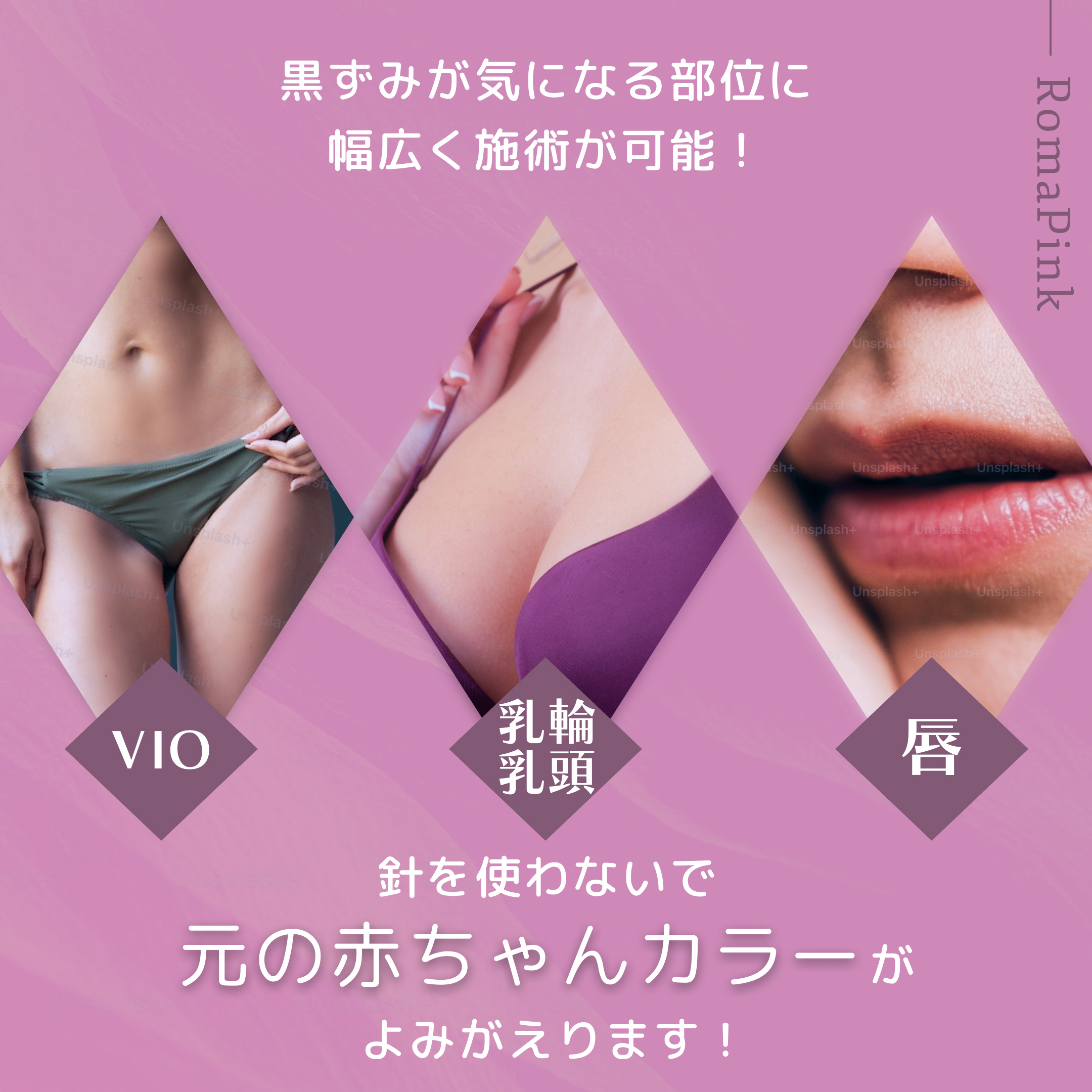 ローマピンク【黒ずみケア】40％OFF