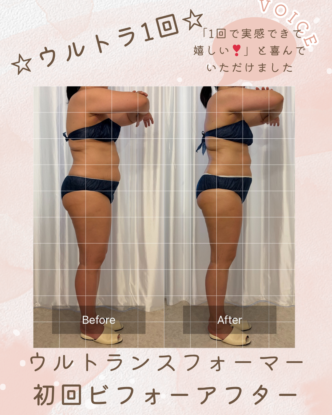 【マシン】最新痩身マシン集中ケア