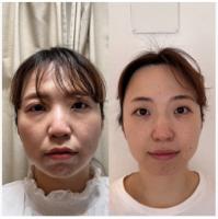 ルート鬼美容鍼メニュー