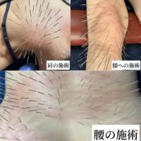 ルート治療メニュー