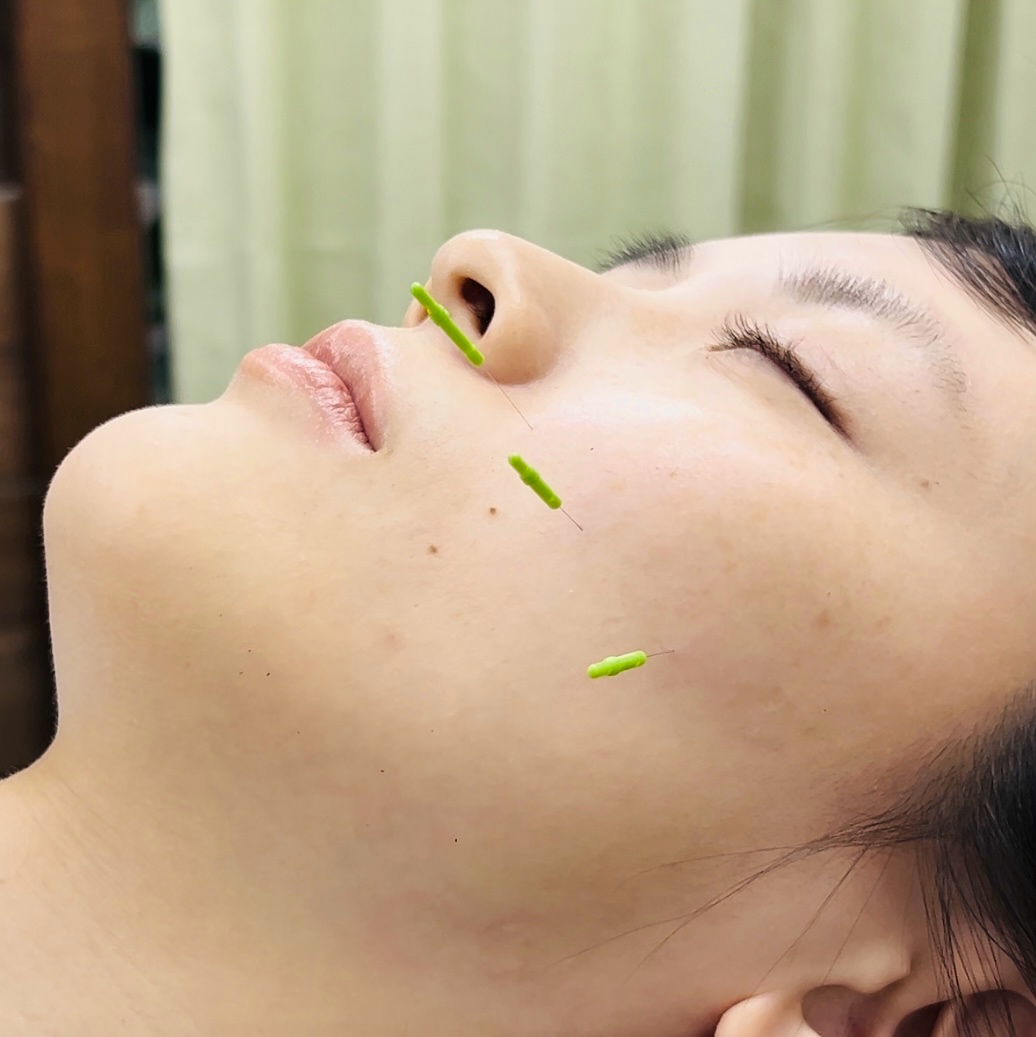 美容鍼メニュー