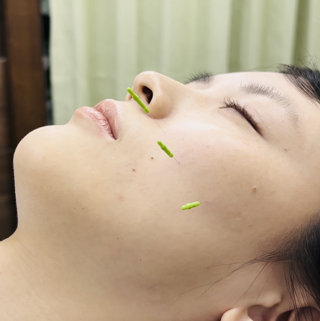 美容鍼メニュー