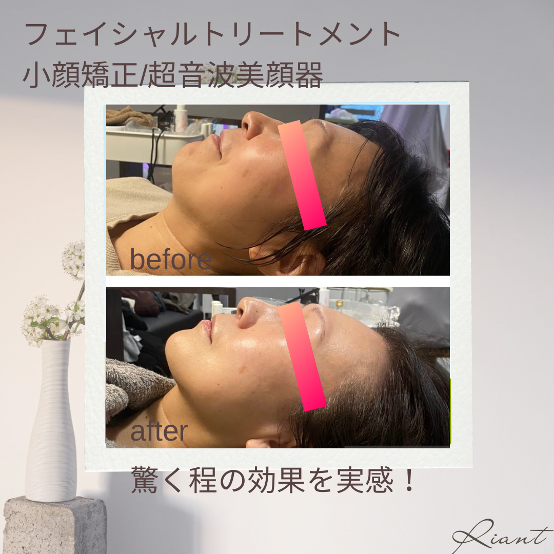 超音波顔筋フェイシャルトリートメント