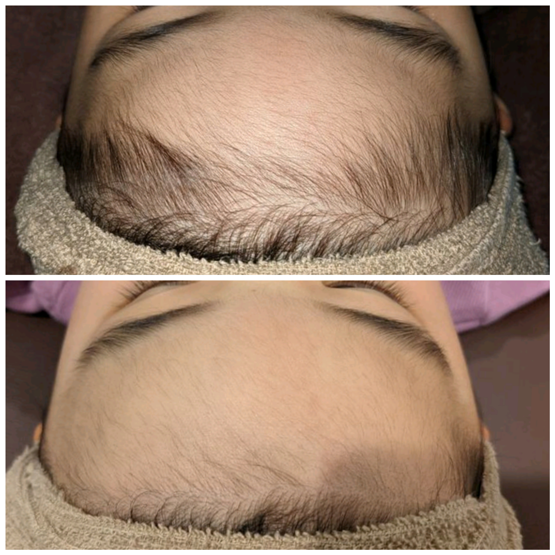 子供脱毛(小学生以下)