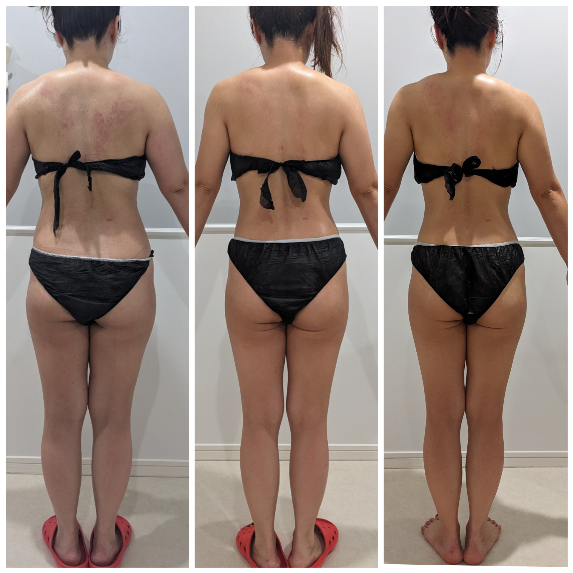 セルライトケア