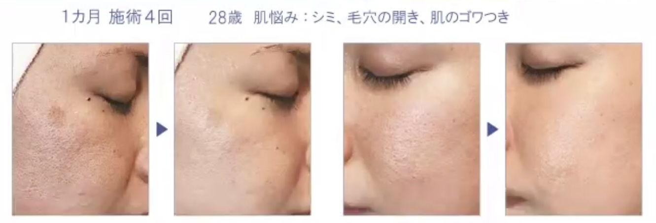 New！肌質改善！ニードル×ピーリング×生コラーゲンで素肌美人！