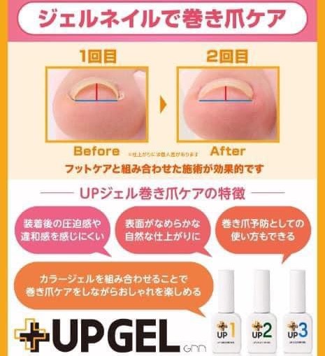 【軽度～中等度の巻き爪補正に】最新巻き爪補正UPジェル