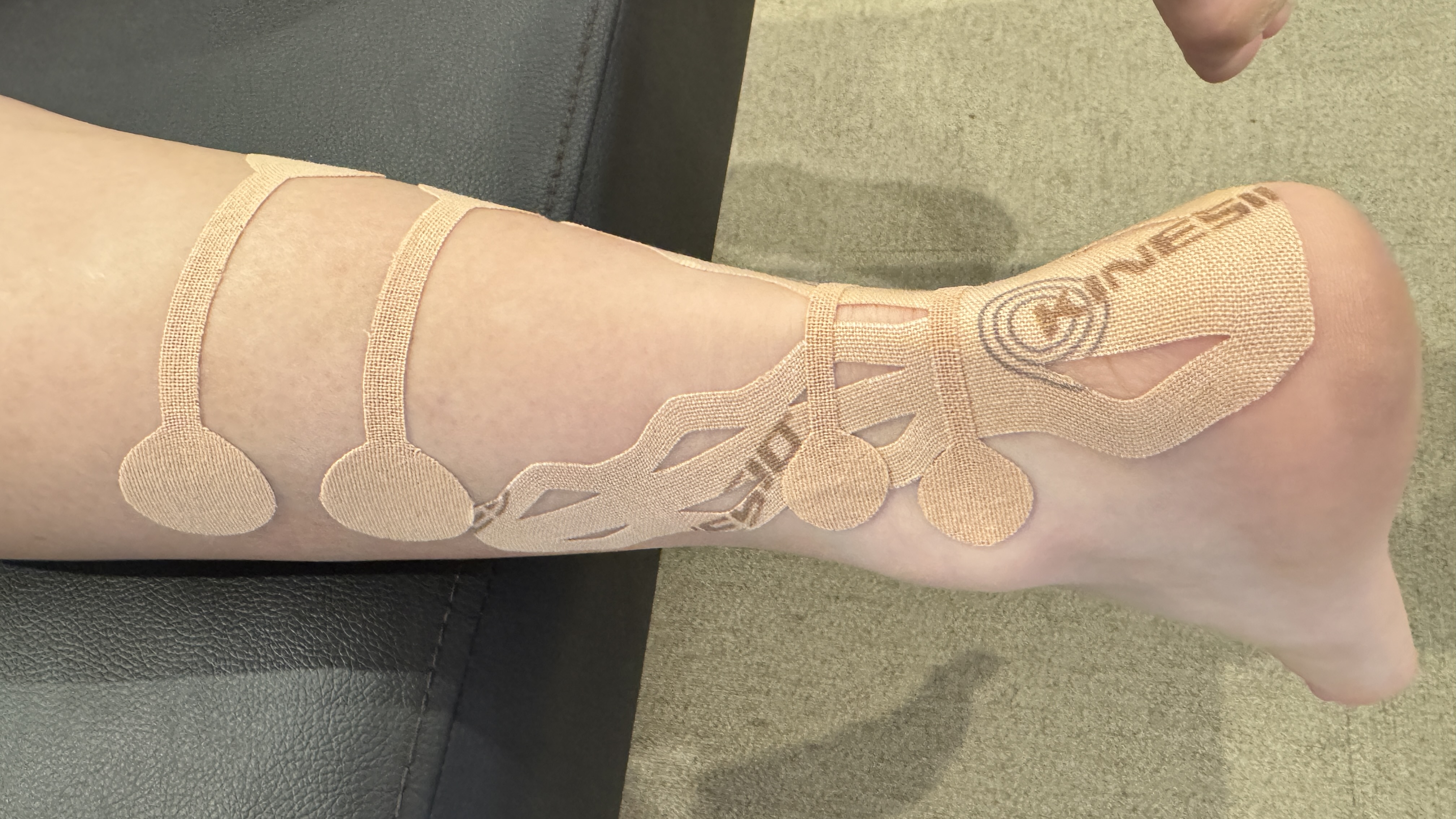 キネシオテーピング療法