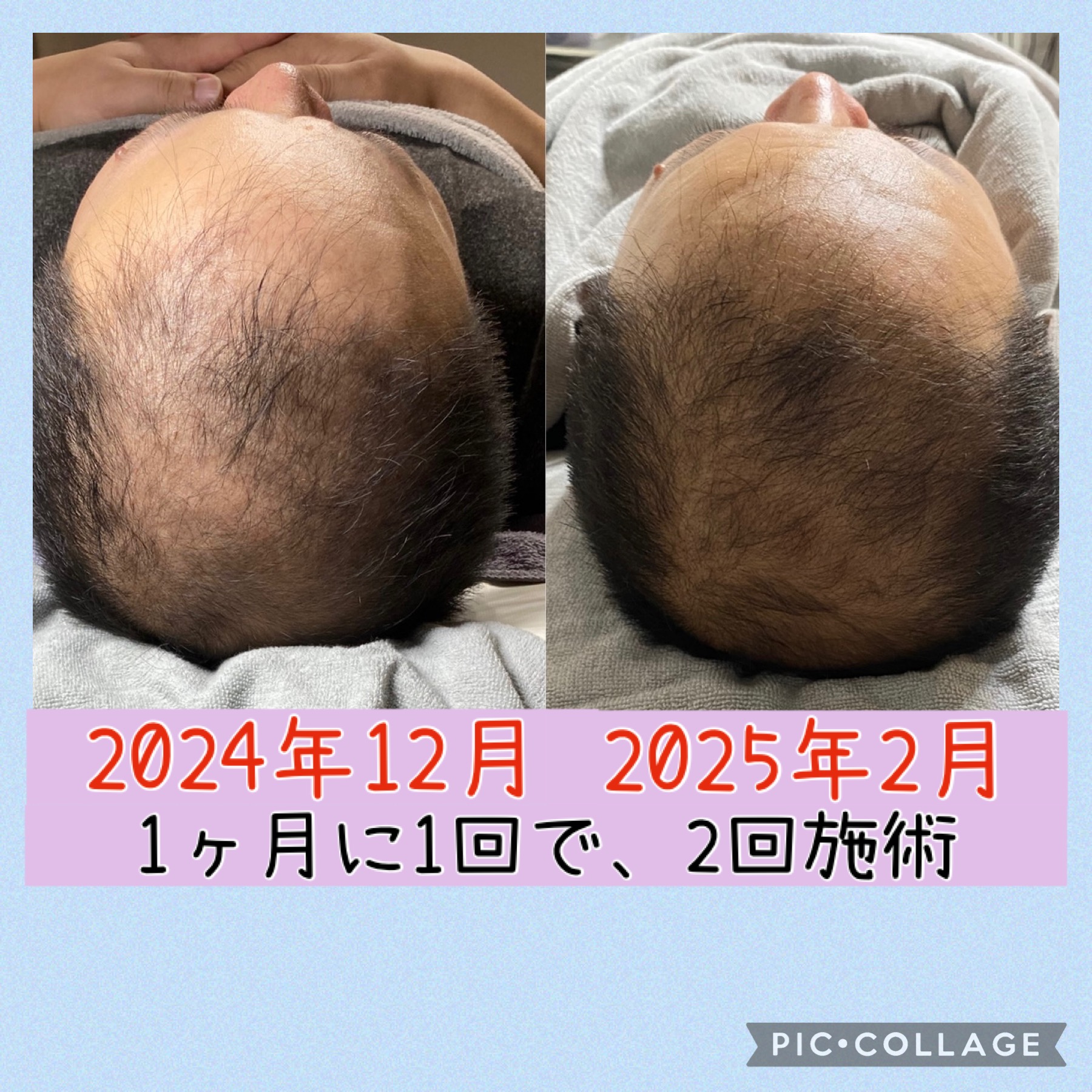★頭髪のボリュームを増やしたいねん！